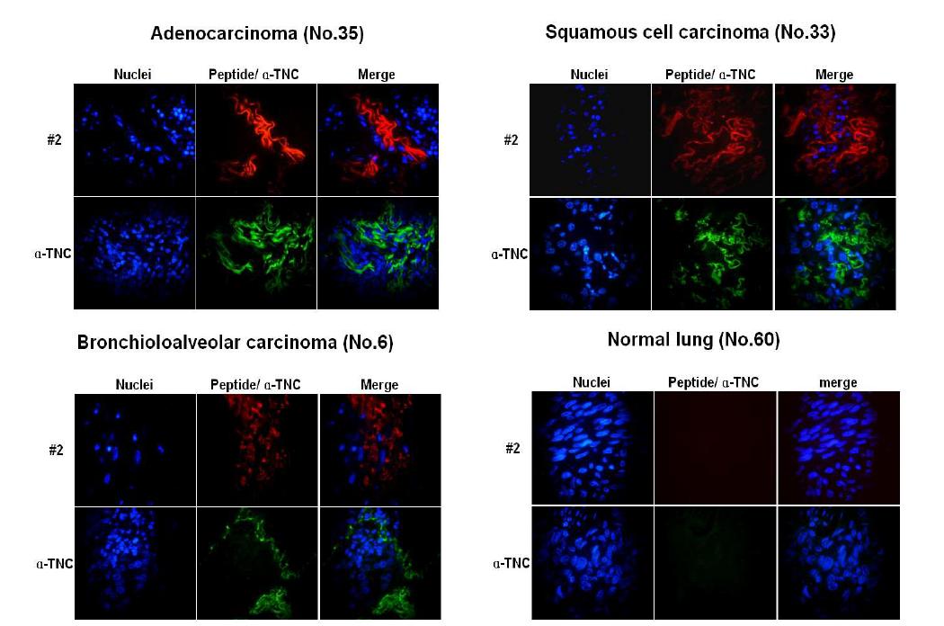 Specific detection TNC by the biotin-peptide #2 to lung cancer patient tissues