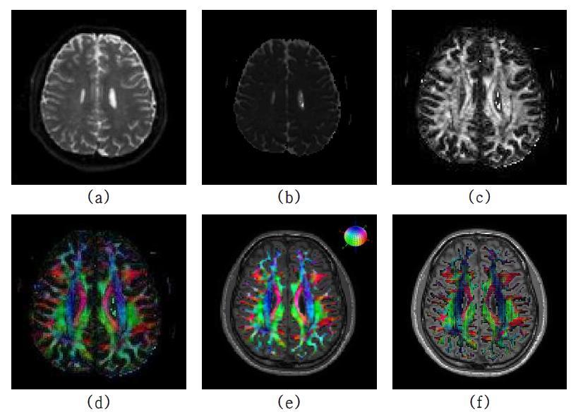 DT-MRI의 대표적인 영상: (a) T2-weighted MRI, (b) MD 영상, (c) FA 영상, (d) color-coded FA map, (e),(f) color-coded FA와 ellipsoid가 MR 영상 위에 overlaid된 영상