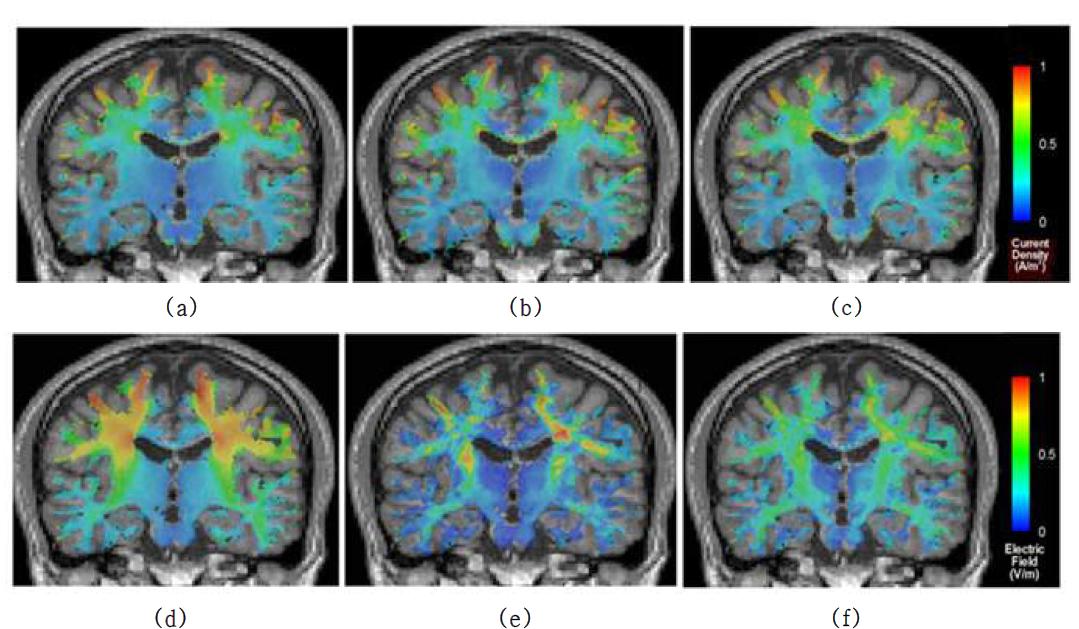 백질 지역의 전류밀도 분포 양상과 (a-c) 전기장 분포 양상 (d-f) : (a), (d) 백질 지역 비등방성비율 1, 두개골 지역 비등방성 비율 7로 고정시킨 모델, (b), (e) 백질 지역 비등방성 비율 5, 두개골 지역 비등방성 비율 7로 고정시킨 모델, (c), (f) 백질 지역의 비등방성 성질을 사실적으로 표현하고 두개골 지역의 비등방성 비율을 7로 고정시킨 모델