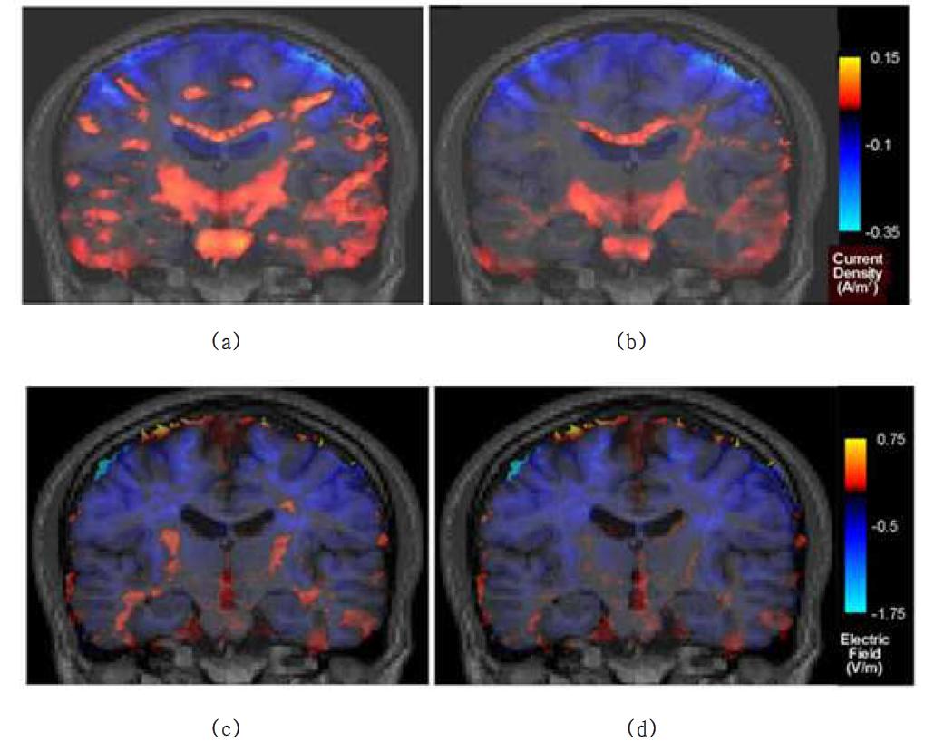 등방성 모델과 비등방성 모델의 전류밀도 (a-b) 와 전기장 (c-d) 차이: (a), (c) 백질 지역 비등방성 비율 10, 두개골 지역 비등방성 비율 7로 고정시킨 모델간의 전류밀도 차감도 (b), (d) 백질 지역의 비등방성 성질을 Variable-ratio로 표현하고 두개골 지역의 비등방성 비율을 7로 고정시킨 모델간의 전기장 차감도