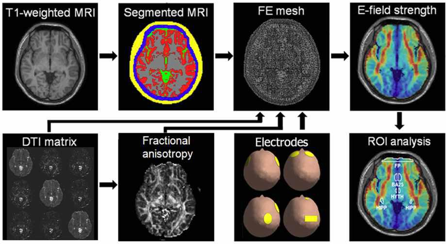 3차원 실제 머리 유한요소 머리 생성 및 전기충격요법에 의해 자극되는 ROI (region of interesting) 지역의 전기장 세기 분석방법