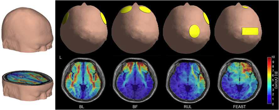 전기충격요법에 의해 사용되어지는 3곳(bi-lateral (BL), bifrontal (BF), right unilateral (RUL)과 focal electrically administered seizure therapy(FEAST) 위치에 전극 부착 후 전기장 발생 양상