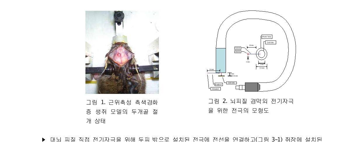 근위축성 측색경화 그림 2. 뇌피질 경막외 전기자극