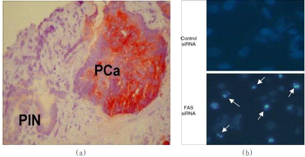 Overexpression of fatty acid synthase in prostatic intraepithelial neoplasia (PIN) and in invasive carcinoma of the prostate (PCa)