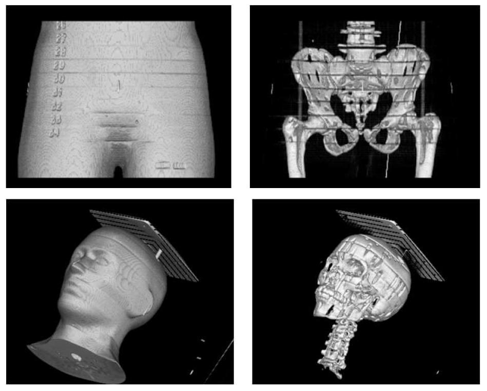 treatment plan 3D visualization for pelvis & head rando phantoms.