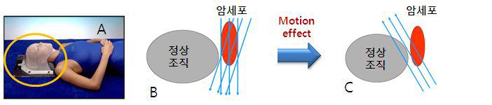방사선 치료에 사용되는 immobilization 장치(A) 및 motion effect(B, C)