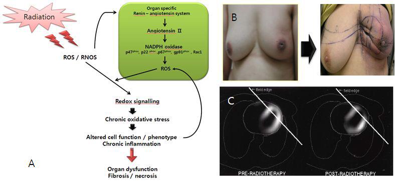 방사선 조사에 의한 염증성 조직손상의 모델(A) 조직손상의 예(B) 및 흉부 방사선 치료에 의한 심독성 (C)