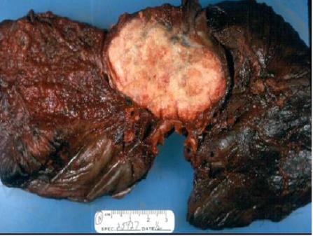 비소세포폐암 (NSCLC)