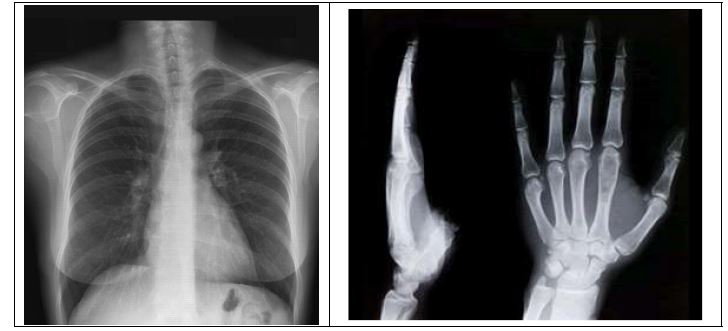 〈그림3〉 일반방사선 촬영: (A) 흉부사진, (B) 손의 뼈사진