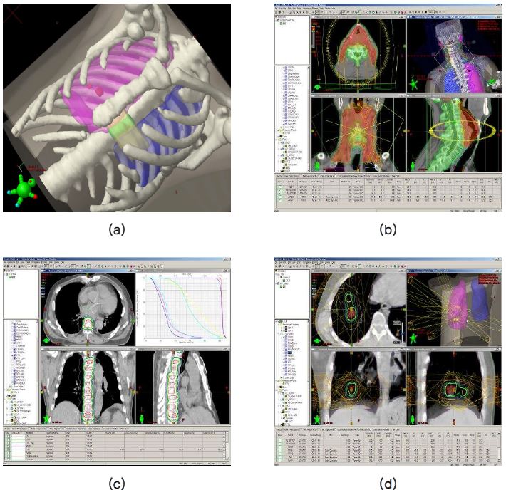 〈그림20〉 컴퓨터를 이용한 방사선치료계획