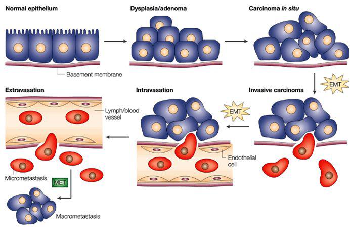 악성종양의 출현과 진행에서 EMT와 MET가 일어나는 부위