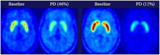 뇌기능 PET영상을 이용한 두 치료약제의 유효성 비교