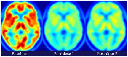 [11C]SA4503 PET영상을 이용한 약물의 뇌 특이 결합능 측정