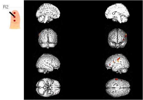 피험자의 오른손 검지 두 번째 위치(R2)에 가벼운 압력의 촉각 자극을 제시하였을 경우 이에 반응하는 뇌의 활성 영역