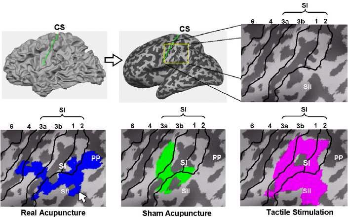 실제 한의학용 침, 모조 한의학용 침 및 플라스틱 고리를 사용한 가벼운 압력의 촉각 자극에 반응하는 뇌의 활성 영역 및 활성 영역의 크기