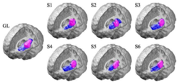 수초신경 이상 환자(GL)와 정상인(S1~S6)의 팔(빨간색)과 다리(파란색)에 부드러운 촉각 자극을 제시하였을 때 대뇌 insular cortex의 활성도
