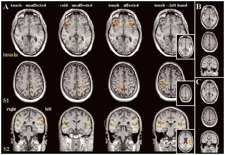 압력 자극과 두 가지 다른 온도 자극(32℃ 및 20℃)에 대한 뇌의 활성 영역