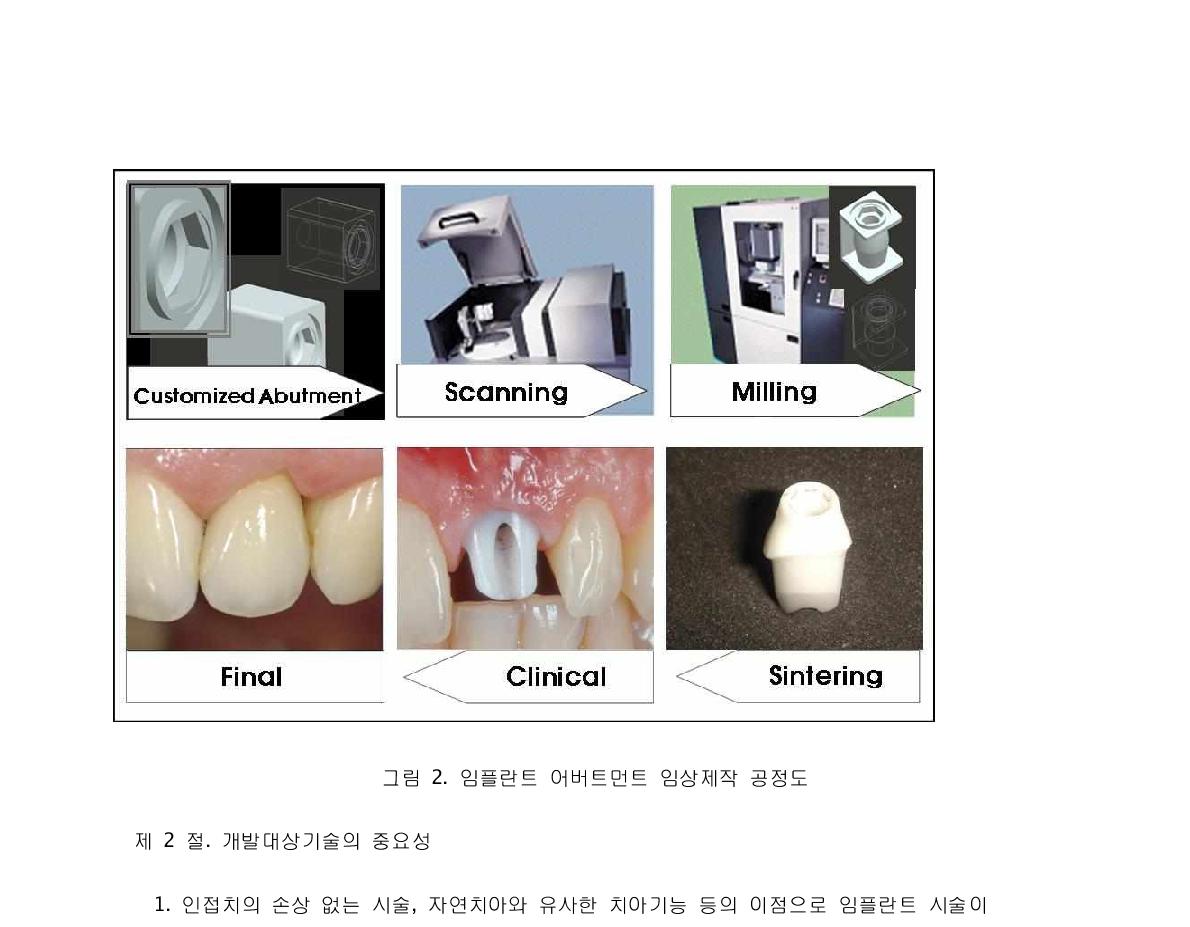 임플란트 어버트먼트 임상제작 공정도