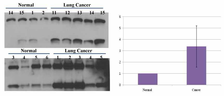 정상인과 폐암환자에 대한 western blot analysis