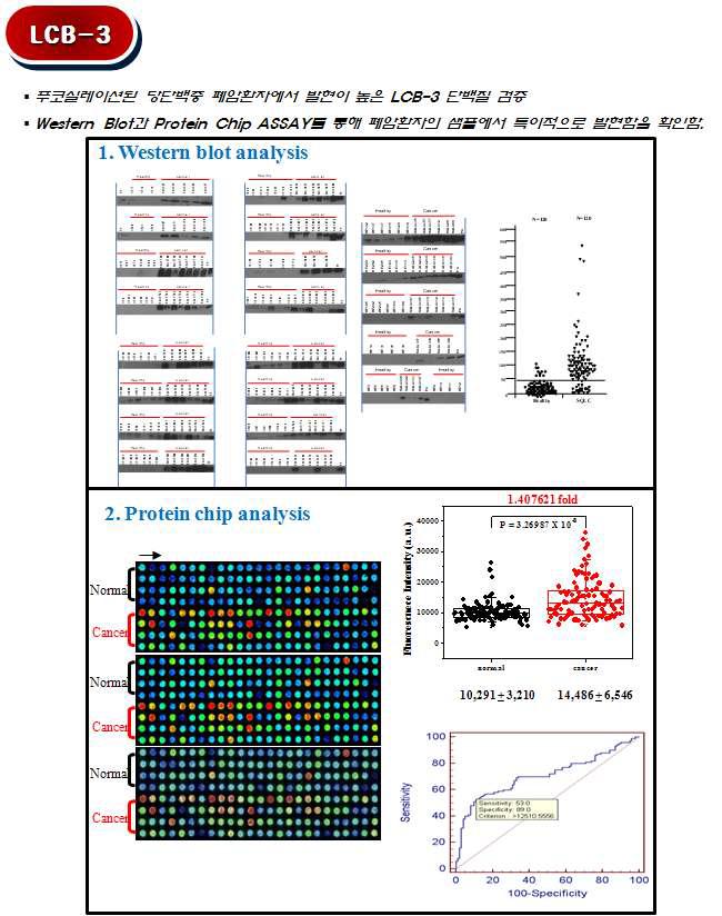정상인과 폐암환자에 대한 LCB-3 마커의 프로테인 칩 결과 및 ROC curve.