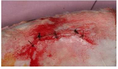 skin suture