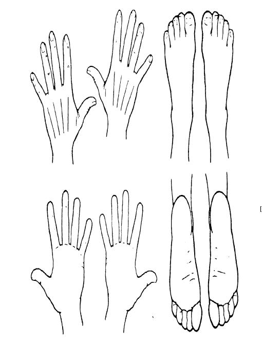 피부 변화의 부위를 기술하기 위한 손과 발의 전후면 그림