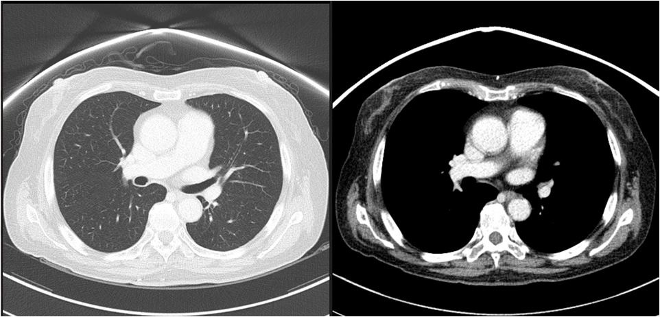 유방부위에 shielding한 후 촬영한 CT