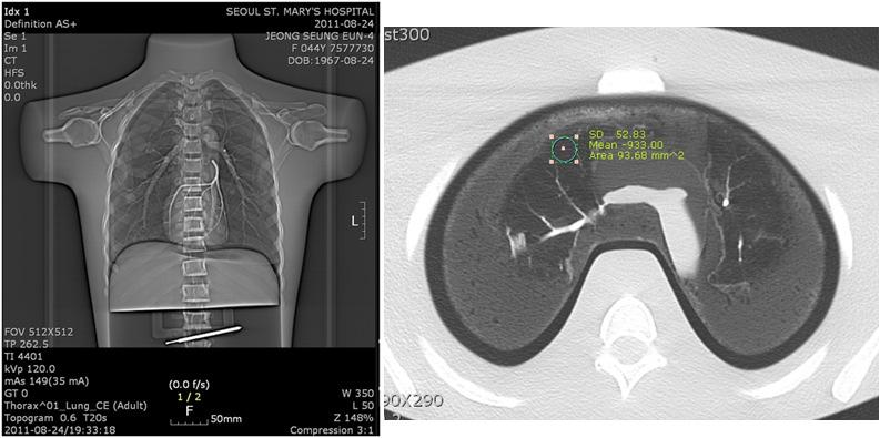 흉부팬텀의 CT localizer 영상과 Axial 영상. Noise 측정한 부위
