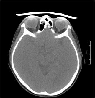 Eye shield 설치 후 CT scan.