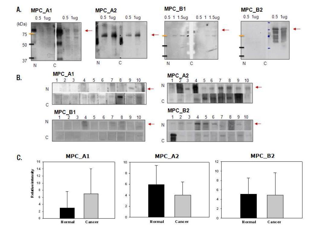 (A) 정상인 (N)과 유방암(C) 환자의 혈액에 포함된 자가항체와 반응을 나타내는 인체 재조합 단백질 MPC_A1, A2, B1, B2의 민감성과 특이성 테스트. 사용한 각각의 재조합 단백질의 크기 위치를 오른편 화살표로 나타내었음. (B) 개별 정상인 (n=10)과 유방암 환자 (n=10)의 혈액을 이용한 MPC_A1, A2, B1, B2의 자가항체 면역반응(western blots) (C) (B)에서 나타난MPC_A1, A2, B2에 대한 자가항체 면역반응의 수준을 임의로 나타낸 막대그래프