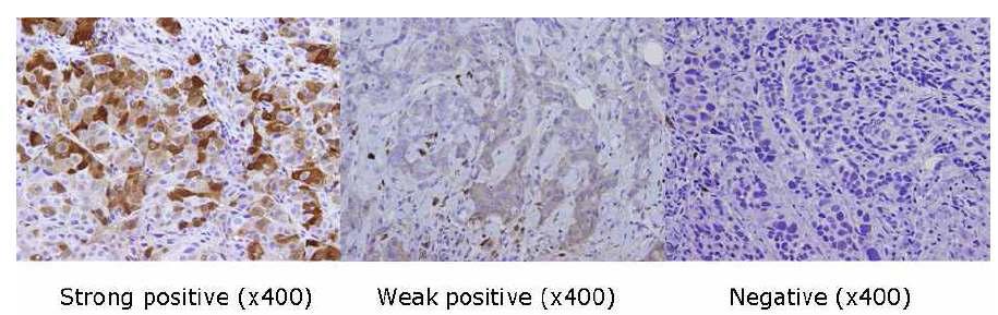 (Immunohistochemistry on the breast cancer tissue in prechemotherapy state)