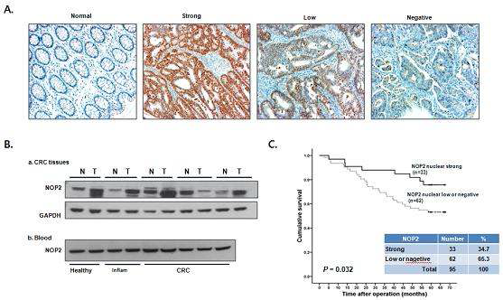면역조직화학적 분석 (A), Western blot 방법 (B)으로 NOP2가 대장암환자 조직 및 혈액에서의 발현을 분석 하고, Kaplan-Meier 방법으로 분석한 결과 NOP2 발현이 좋은 예후와 연관이 있었다.