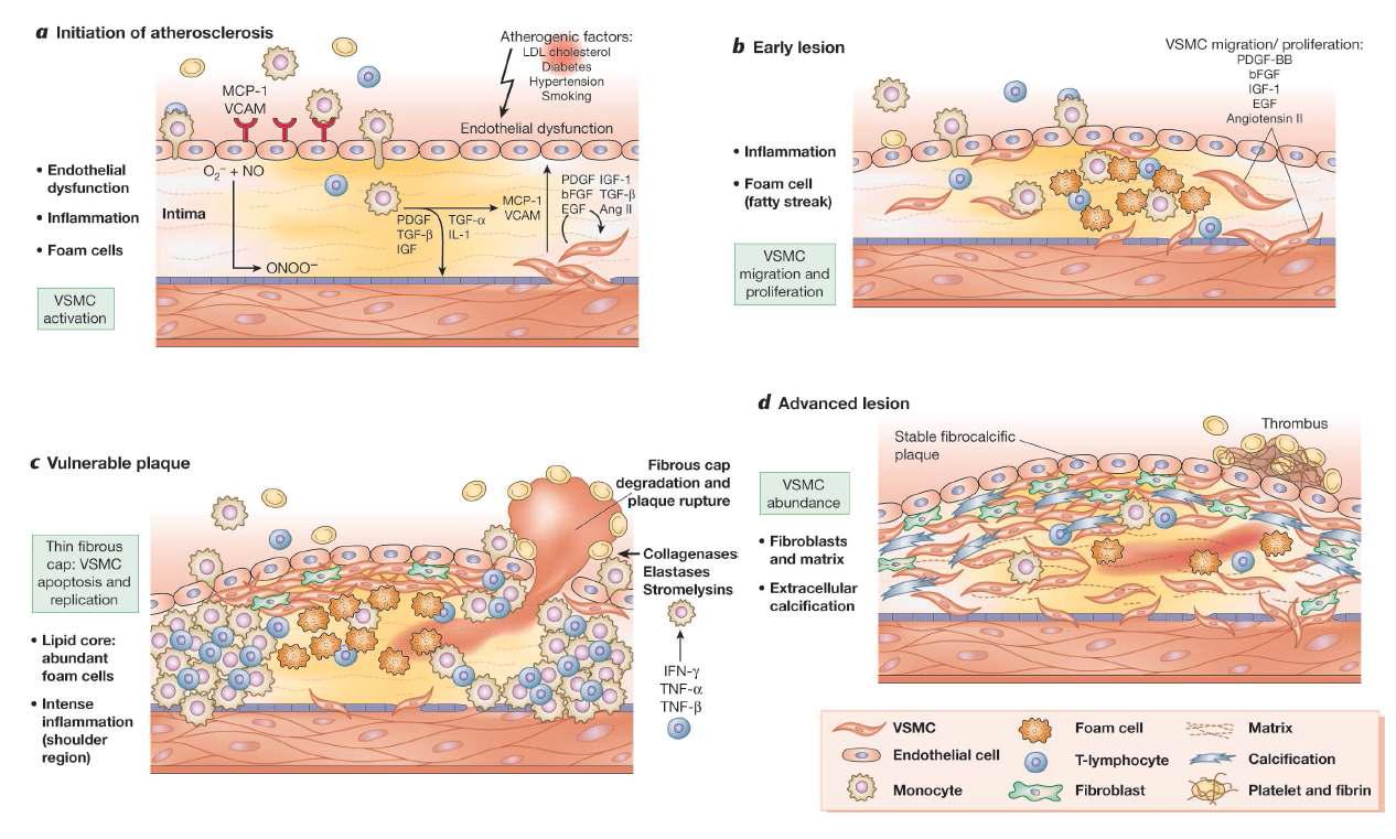 동맥경화 경과에 따른 EC, SMC, macrophage 등의 역할 1)