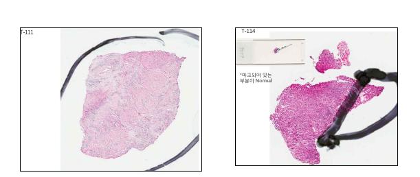 Macrodissection을 통한 암세포 분리의 예