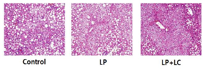 Haematoxylin and eosin (H&E) stain of a section of liver showing the histologic appearance of hepatic fatty change.