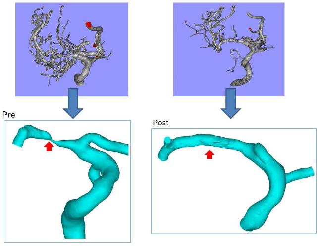 전산혈류 역학적 분석을 위한 3D Data의 단순화 결과(스텐트 시술 전·후)