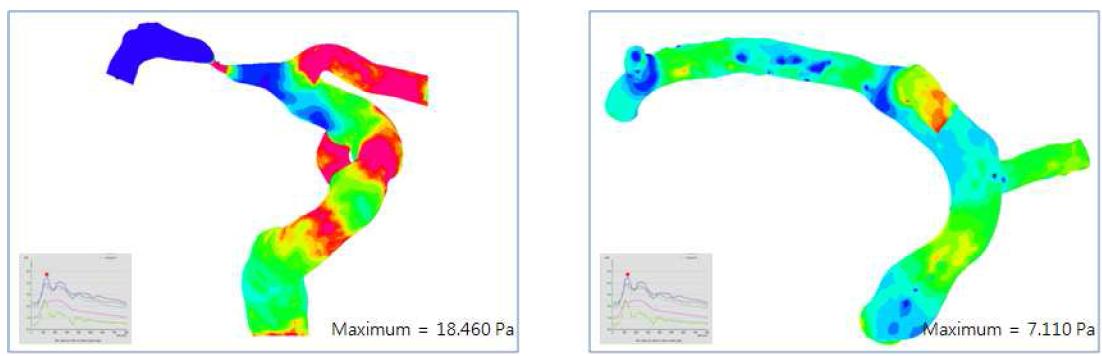 WSS(Wall shear stress) 해석 결과(스텐트 시술 전·후)