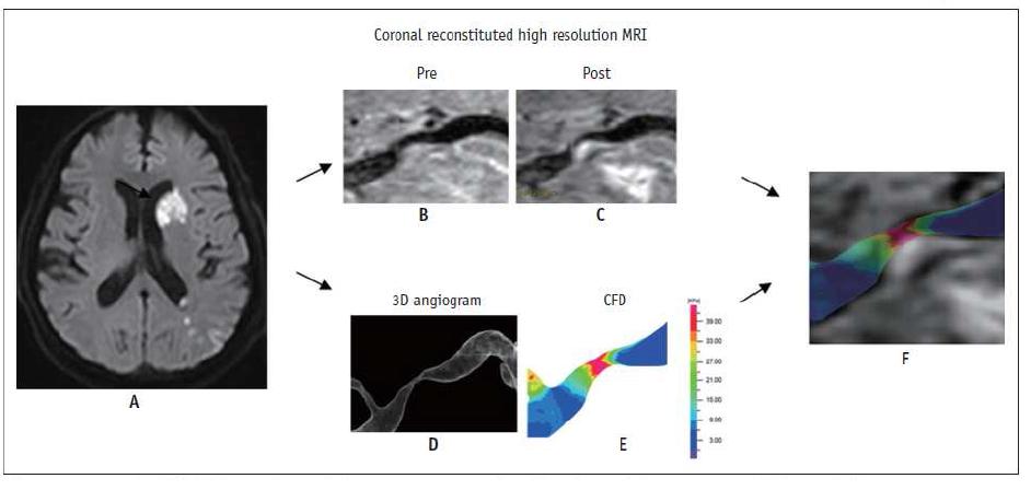 CFD study in severe M1 stenosis with enhanced plaque seen on high resolution MRI