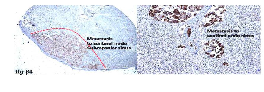 임파선전이를 보이는 종양세포에서 integrin β4의 조직 내 발현.