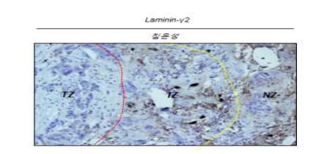 침윤성 유방조직상 변연부의 laminin-γ2 과발현.