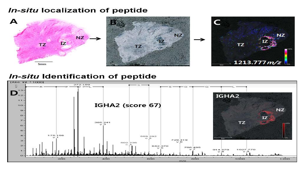 Direct tissue MALDI-MSMS 방법을 이용하여 유방암 조직 변연부에서 IGHA2 발굴