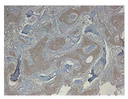 The expression of RUNX3 in oral squamous cell carcinoma.