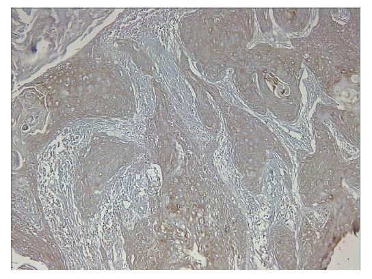 The expression of RUNX3 in oral squamous cell carcinoma.