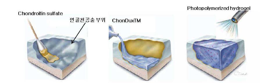 연골 결손 부위에 생체접착성을 가지는 chondroitin sulfate 유사체를 도포한 후,PEG와 히알루론산의 혼합물(ChonDuxTM)을 도포한 후 광중합반응을 통해 하이드로젤 형태로 변화시킴.