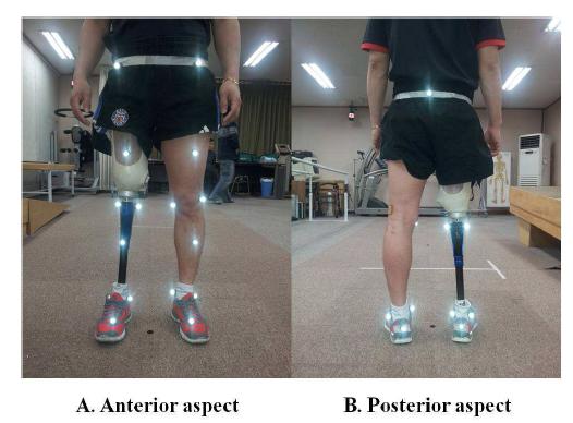 연구대상자의 대퇴 의지 착용 모습과 마커 부착 모습 (A.전면, B.후면)
