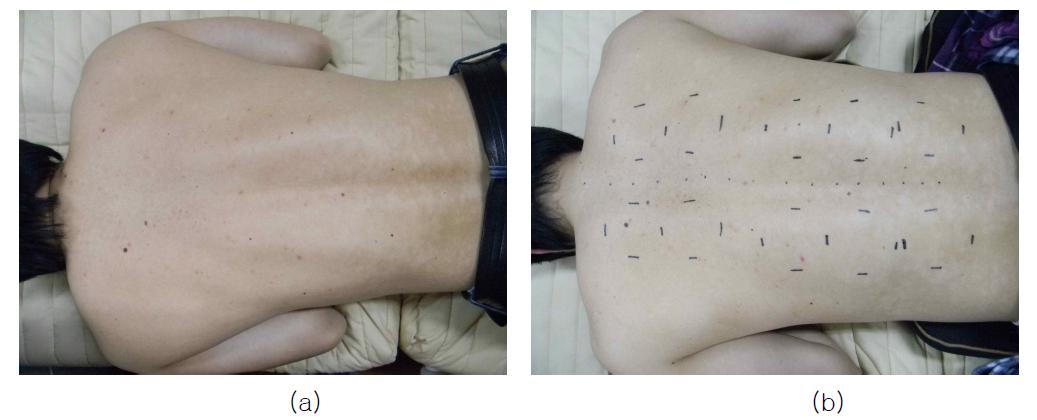 (a) 피실험자의 측정 자세 (b) 척추뼈를 기준으로 배수혈 자리 표시