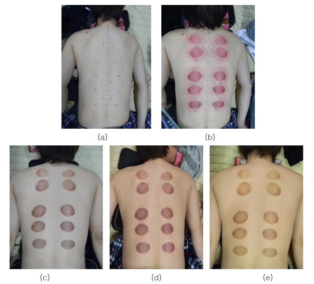 자극 및 시간에 따른 배수혈 사진 (a)자극 전 (b)자극 직후 (c)자극 후, 24시간 경과 (d)자극 후, 48시간 경과 (e)자극 후, 72시간 경과