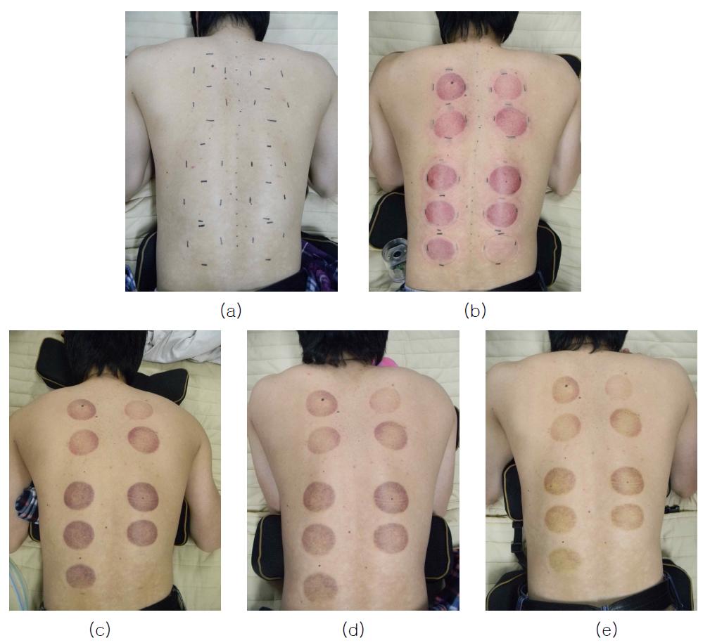 자극 및 시간에 따른 배수혈 사진 (a)자극 전 (b)자극 직후 (c)자극 후, 24시간 경과 (d)자극 후, 48시간 경과 (e)자극 후, 72시간 경과