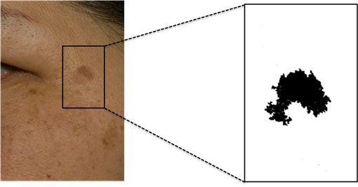 Photoshop을 이용한 특정 부위(Dark spot) 분석