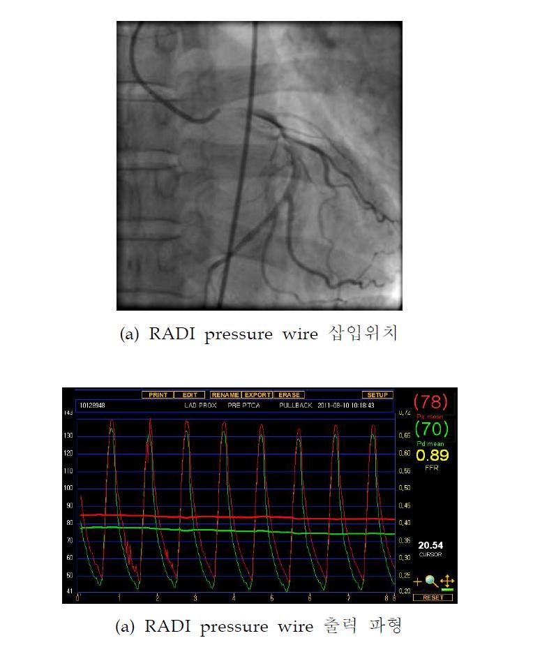 RADI pressure wire를 이용한 대동맥 파형 수집